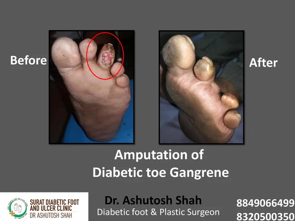 Gangrene and Amputation.pptx-9.webp